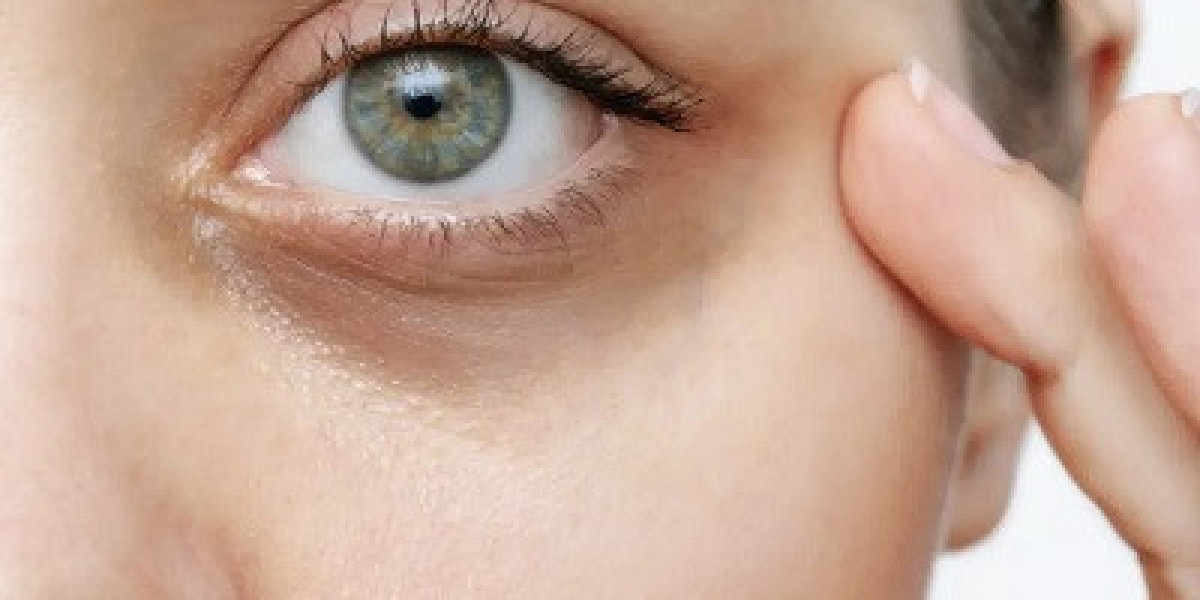 كيف تخلصت من الهالات السوداء في شهر واحد؟