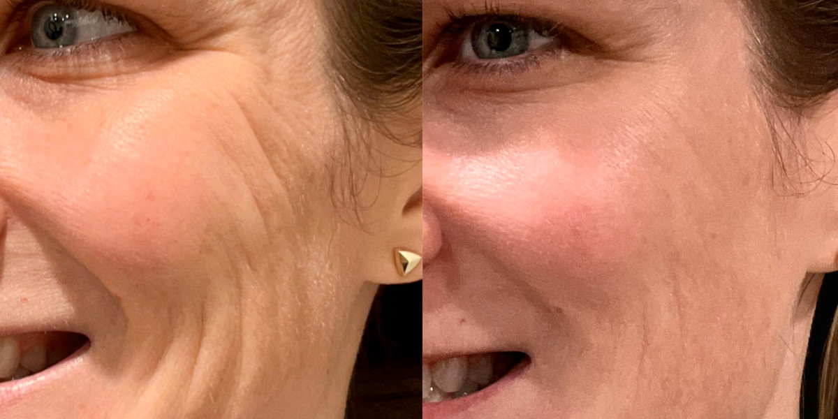 Radiesse vs Sculptra: Which Filler is Right for You?
