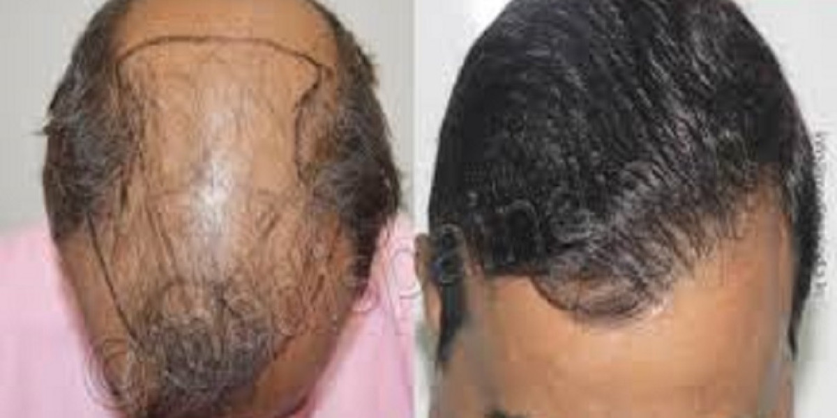Your Complete Resource for Hair Transplants in Riyadh