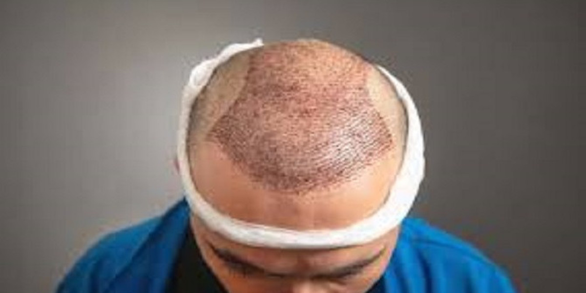 A New Look: Hair Transplant Options in Riyadh