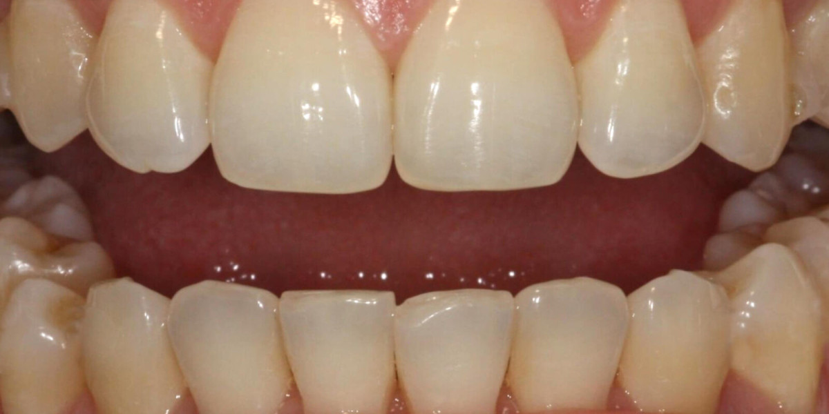 Understanding Teeth Filling: How Clarity Dental Can Restore Your Smile