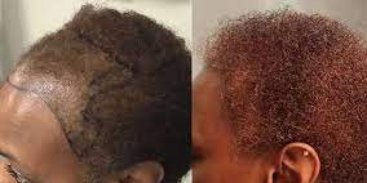 Afro Hair Transplant Istanbul – Precision, Innovation, and the Celebration of Texture
