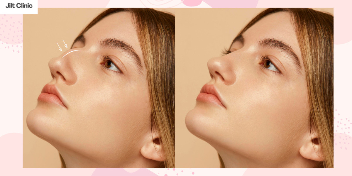 Nasenkorrektur Zürich: Sanfte Wege zu einer harmonischen Nasenform